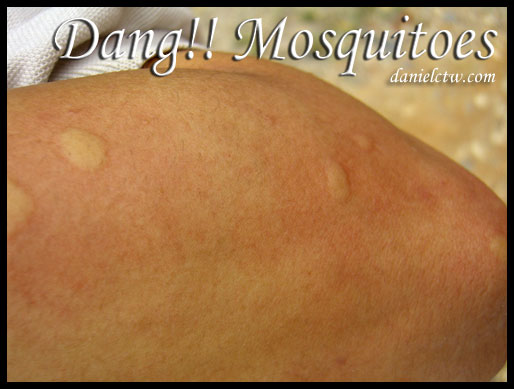 Mosquito Bites