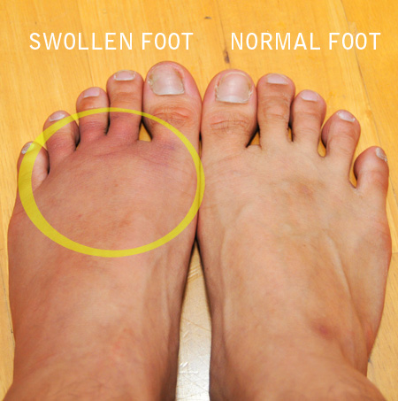 Inflamed Swollen Feet 103